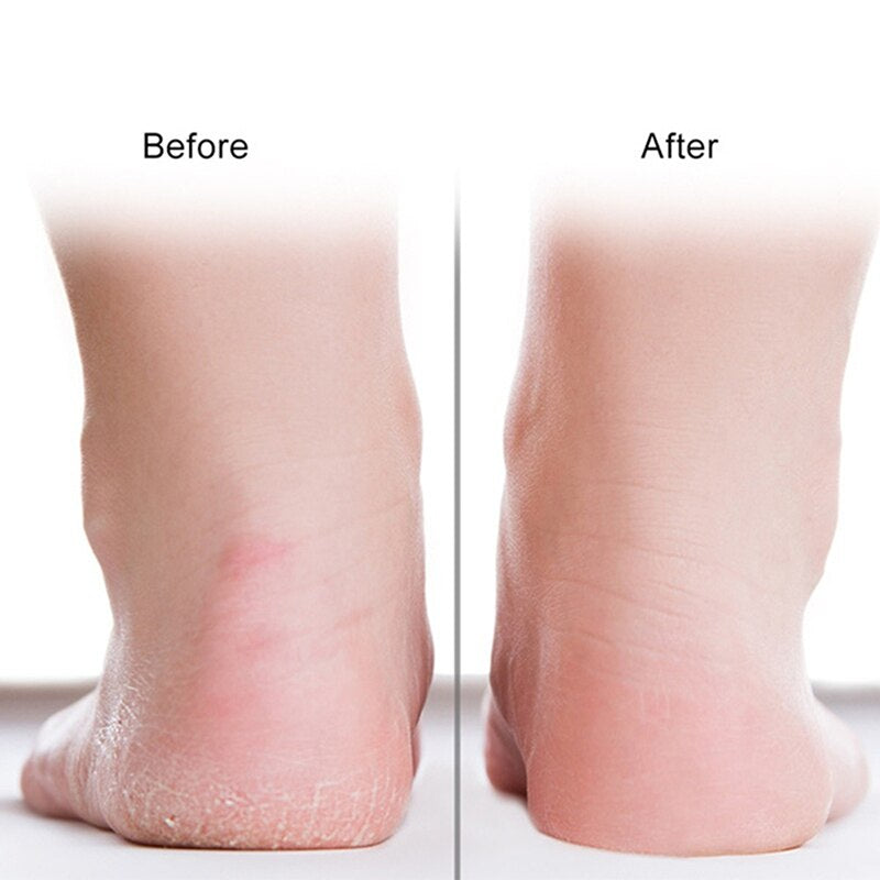 "Revitalize and Soothe Your Feet with Silicone Gel Heel Socks - Ultimate Solution for Cracked Skin, Chapped Care, and Pedicure Health!"